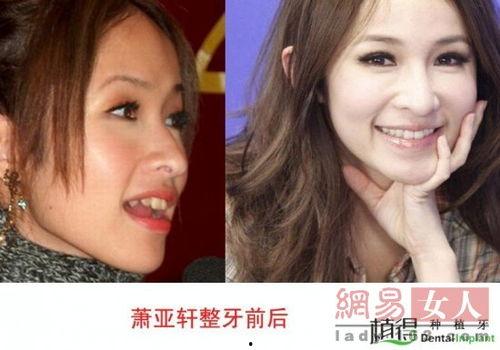 明星种植牙的,美丽微笑的蜕变之旅